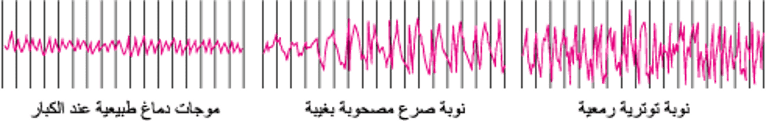 نشاطُ الدماغ في أثناء النَّوبة