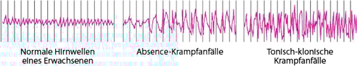 Gehirnaktivität während eines Anfalls