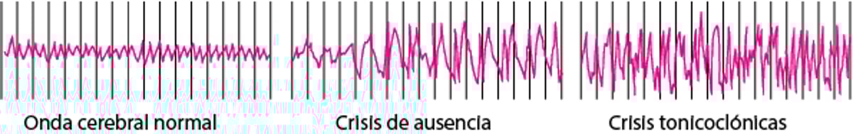 Actividad del cerebro durante una crisis epiléptica