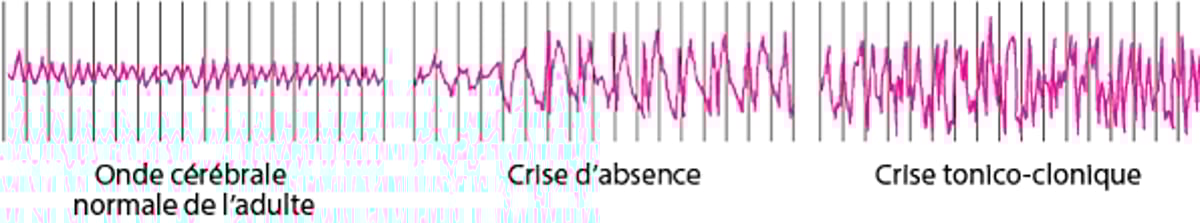 Activité cérébrale pendant une crise