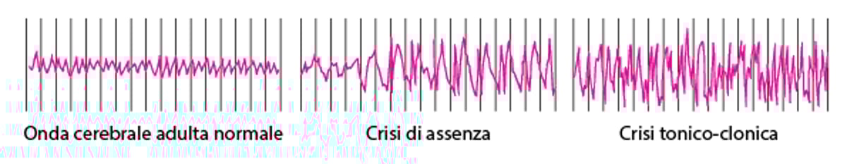 Attività cerebrale durante una crisi convulsiva