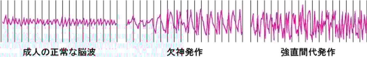 発作中の脳の電気的活動