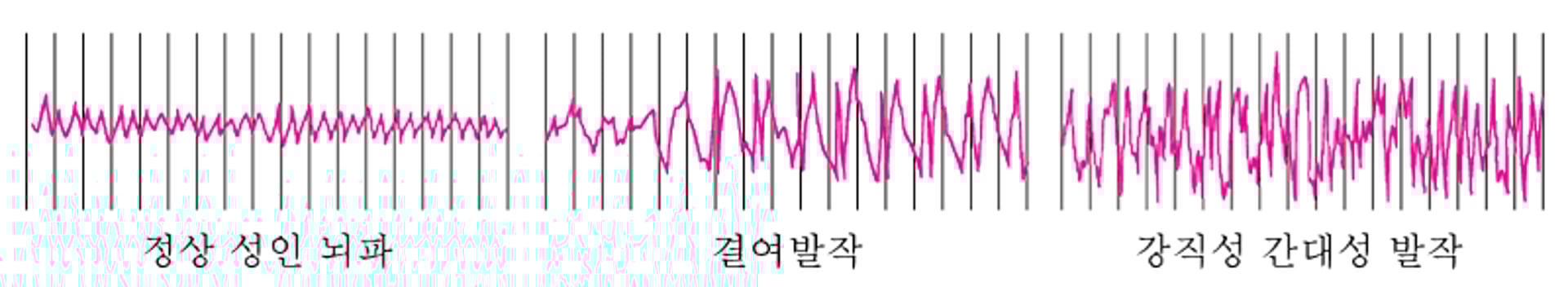 발작 중 뇌 활동