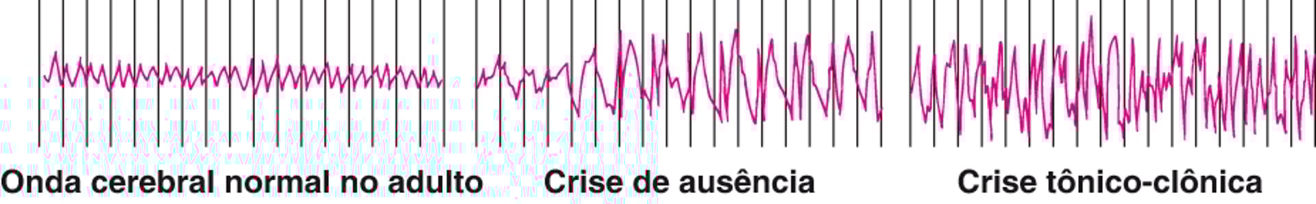 Atividade cerebral durante uma convulsão
