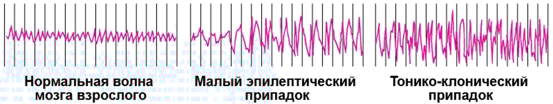 Активность головного мозга во время припадка