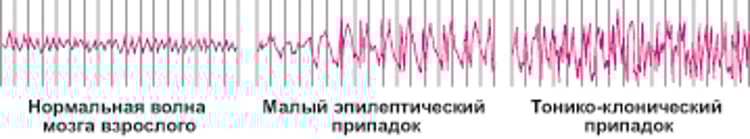 Активность головного мозга во время припадка