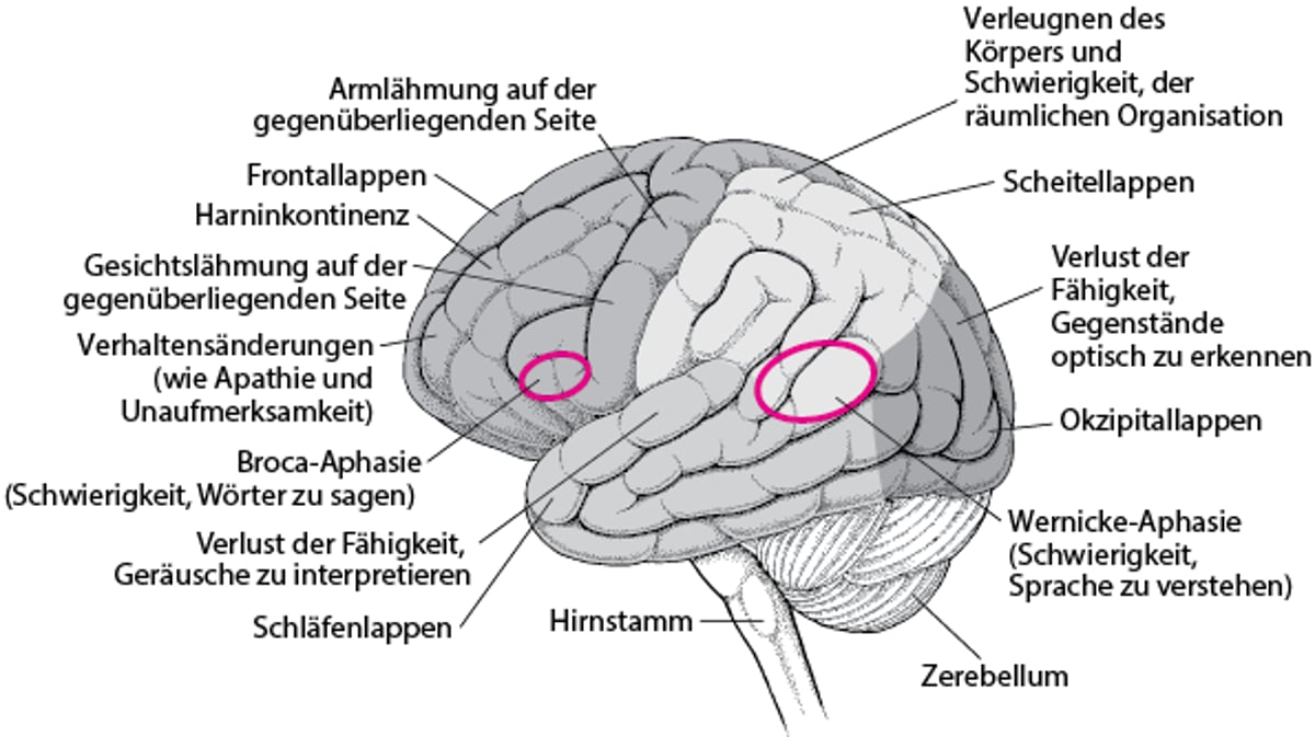 Schädigung bestimmter Gehirnregionen und ihre Folgen
