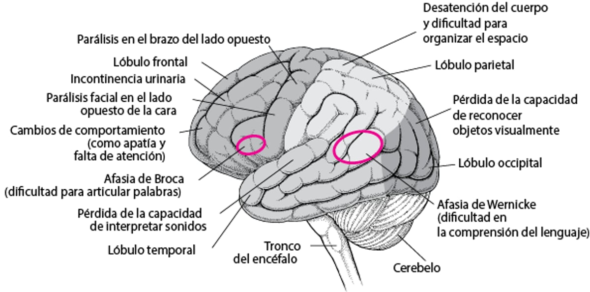 Cuando se dañan áreas cerebrales específicas