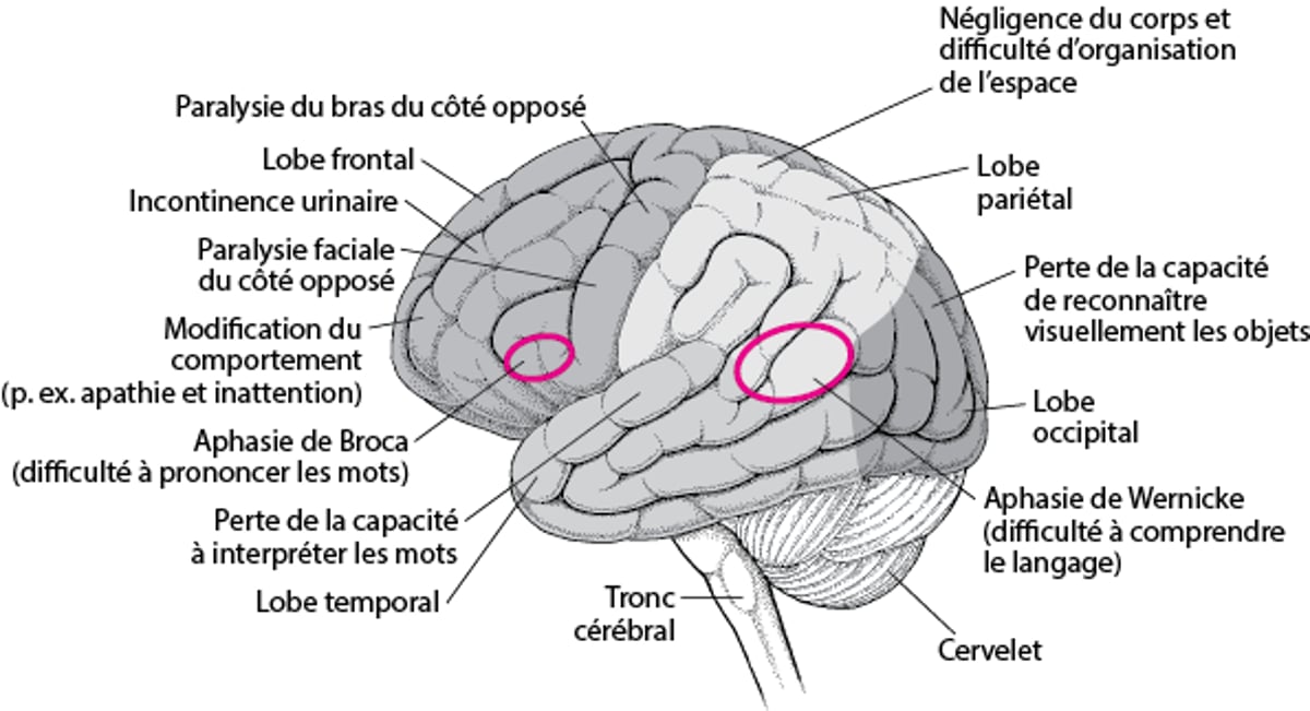 Lorsque des zones spécifiques du cerveau sont lésées