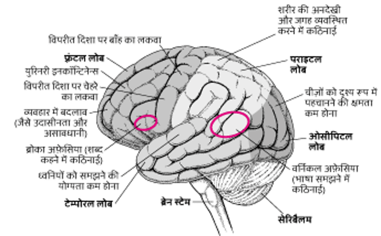 जब मस्तिष्क के विशिष्ट क्षेत्र क्षतिग्रस्त हो जाते हैं