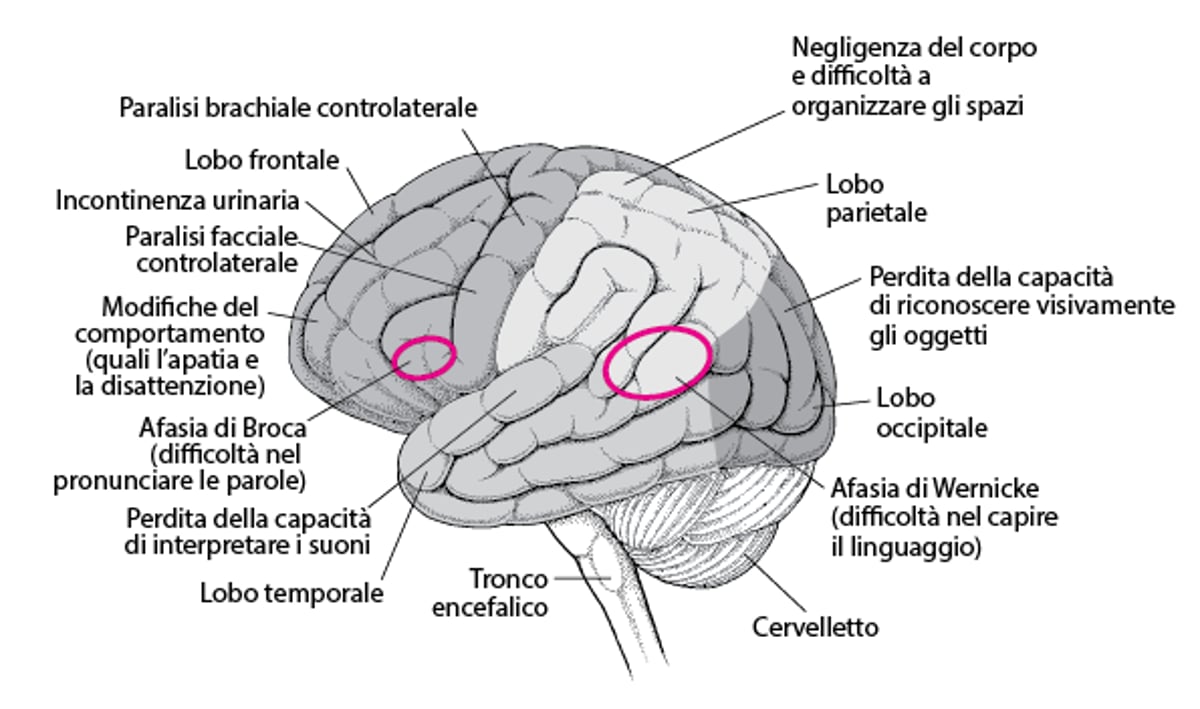 Lesioni a specifiche aree cerebrali