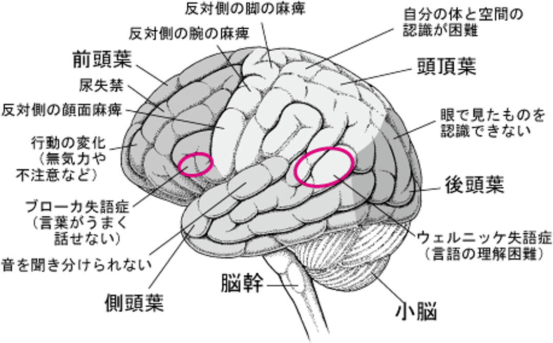 脳の特定の領域が損傷すると…