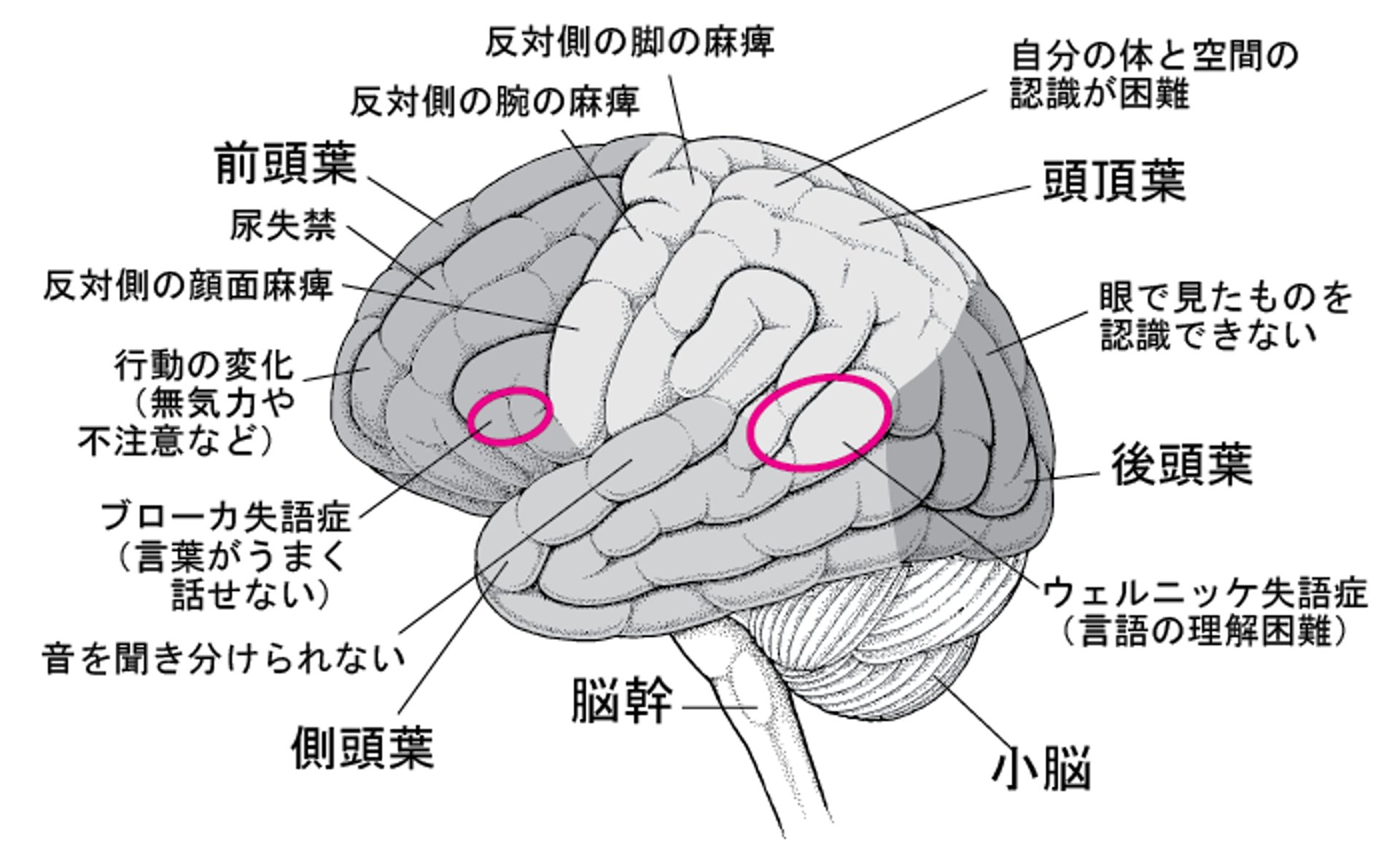 脳の特定の領域が損傷すると…