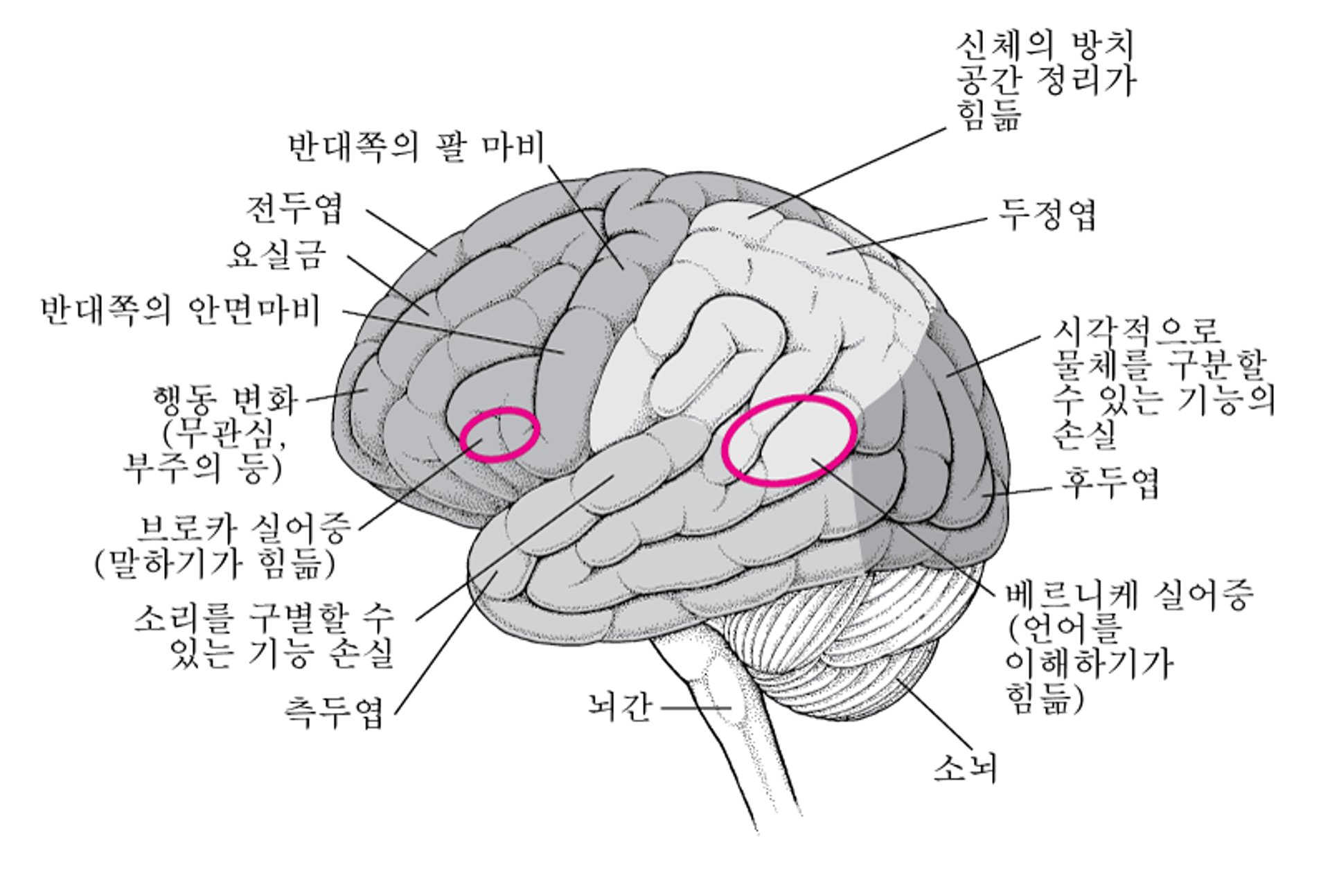 뇌의 특정 영역들이 손상된 경우