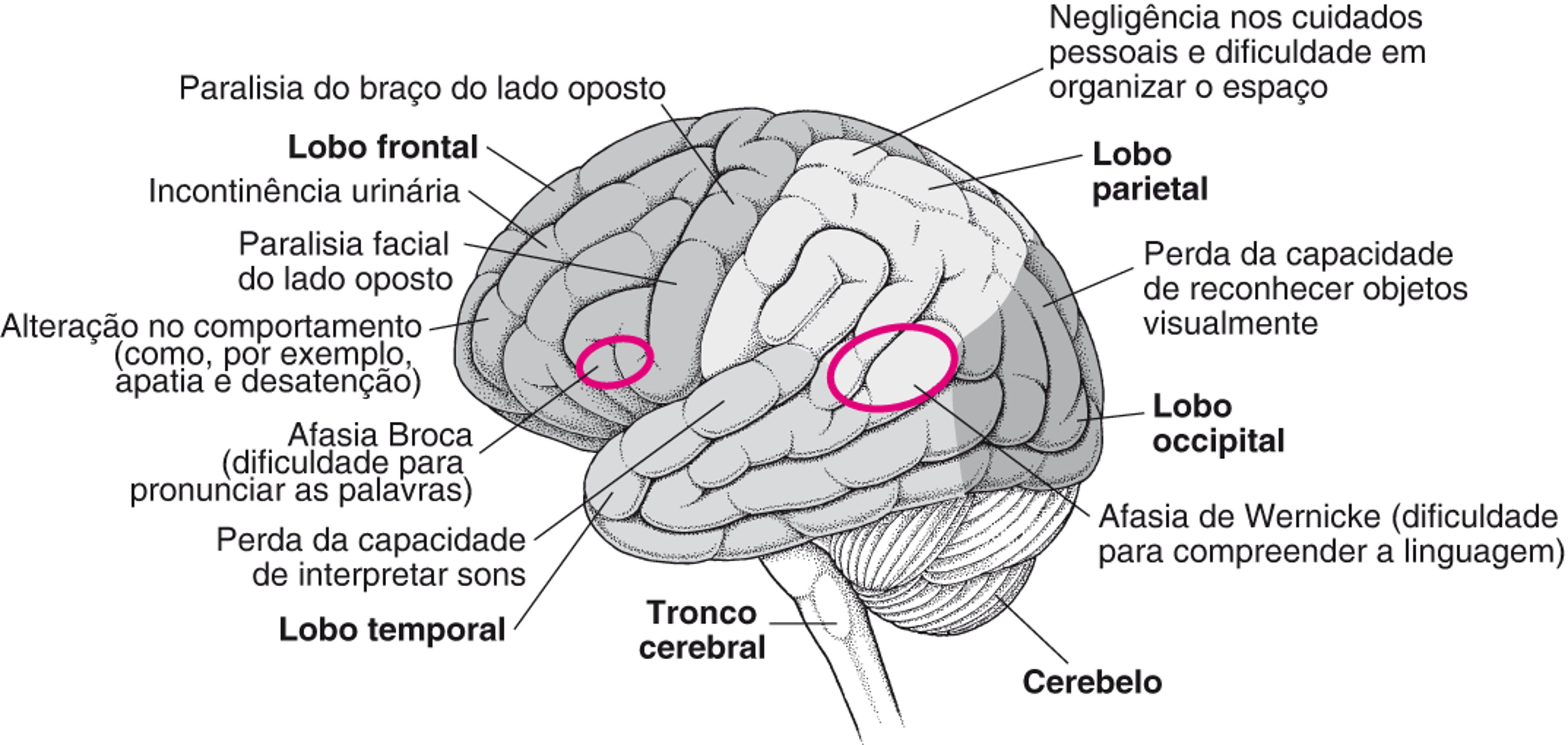 Quando áreas específicas do cérebro são lesionadas