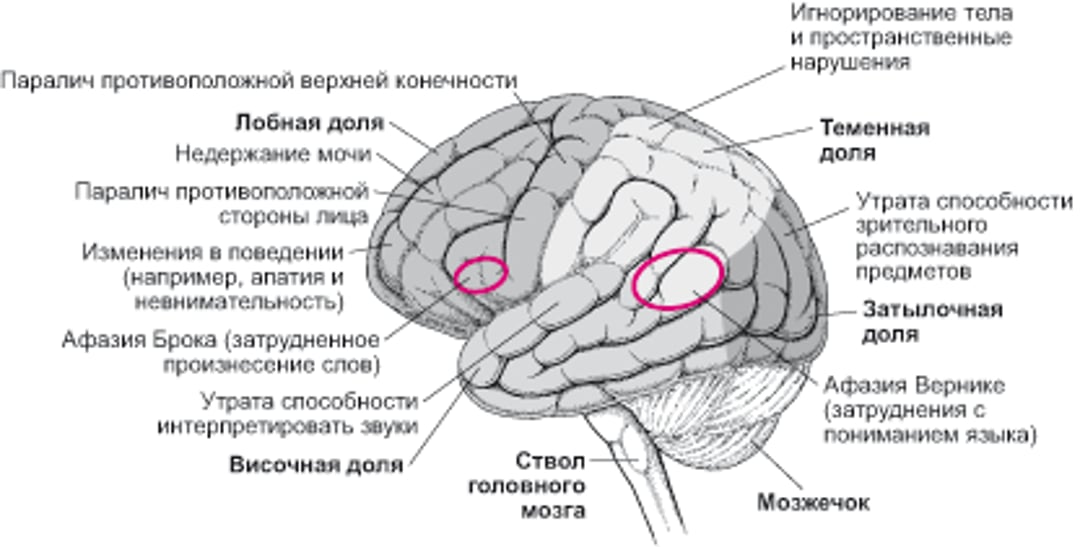 Когда повреждаются определенные области головного мозга