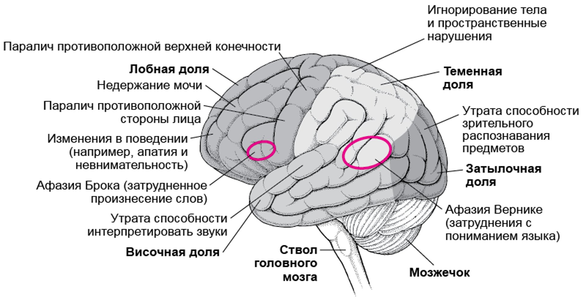 Когда повреждаются определенные области головного мозга