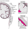 Bursts and Breaks: Causes of Hemorrhagic Stroke