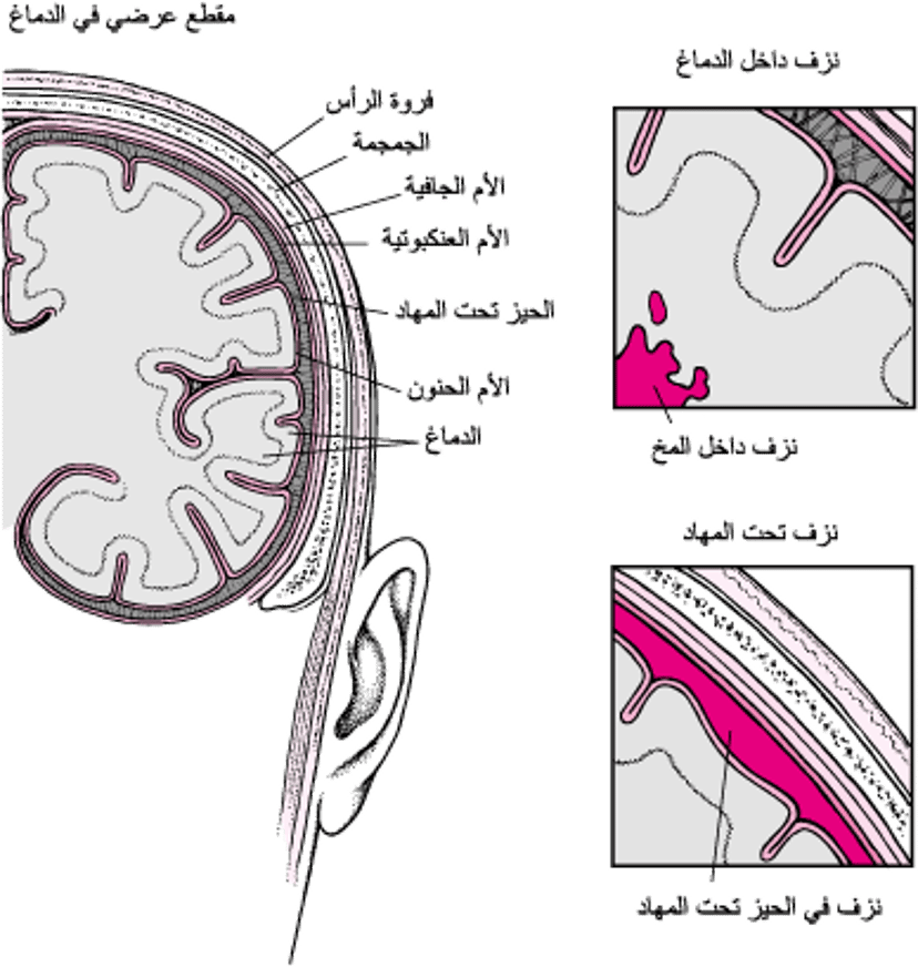 التمزقات والأذيات: أسباب السكتة الدماغية النزفية