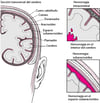 Estallidos y roturas: causas del accidente cerebrovascular hemorrágico (derrame cerebral o ictus hemorrágico)