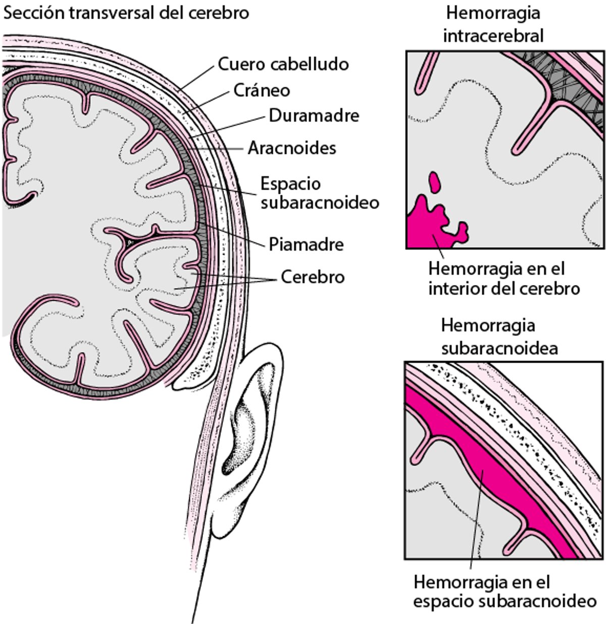 Estallidos y roturas: causas del accidente cerebrovascular hemorrágico (derrame cerebral o ictus hemorrágico)