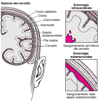 Esplosioni e rotture: cause di ictus emorragico