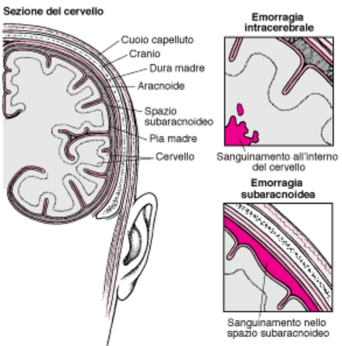 Esplosioni e rotture: cause di ictus emorragico