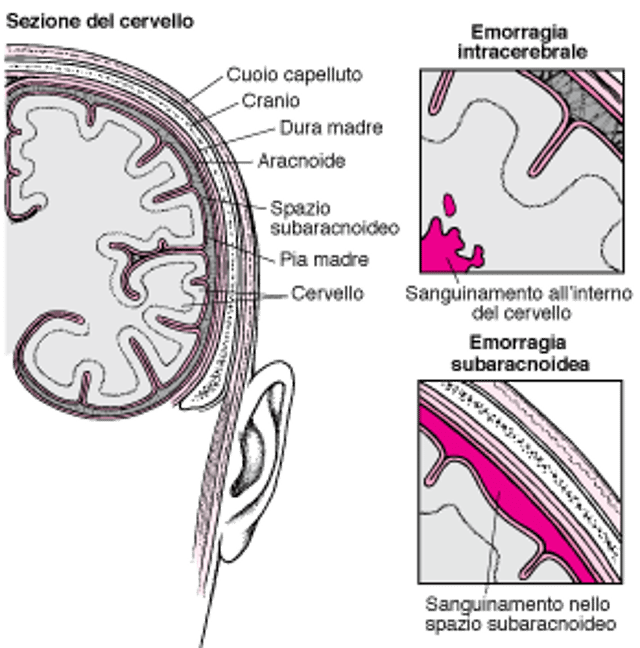 Esplosioni e rotture: cause di ictus emorragico