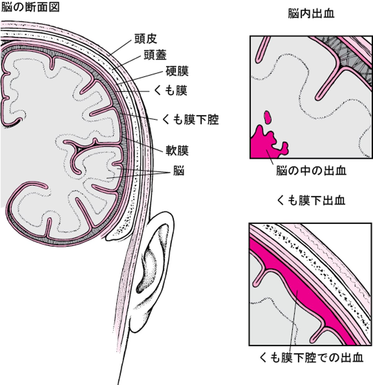 破裂はれつと破綻はたん：出血性しゅっけつせい脳卒中のうそっちゅうの原因げんいん