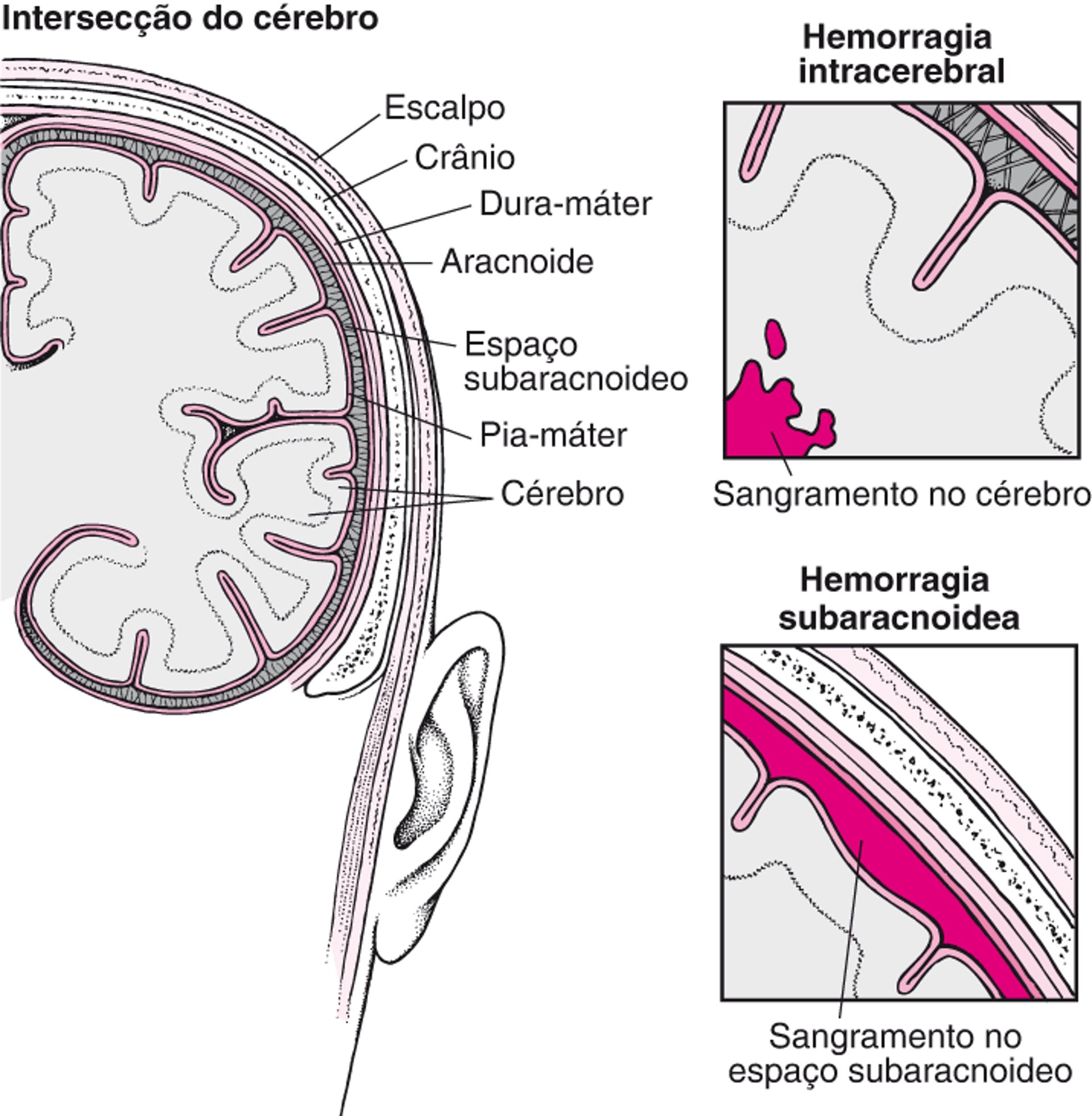 Erupções e rupturas: Causas do acidente vascular cerebral hemorrágico