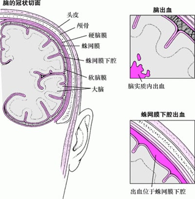 爆发和破裂：出血性卒中的病因