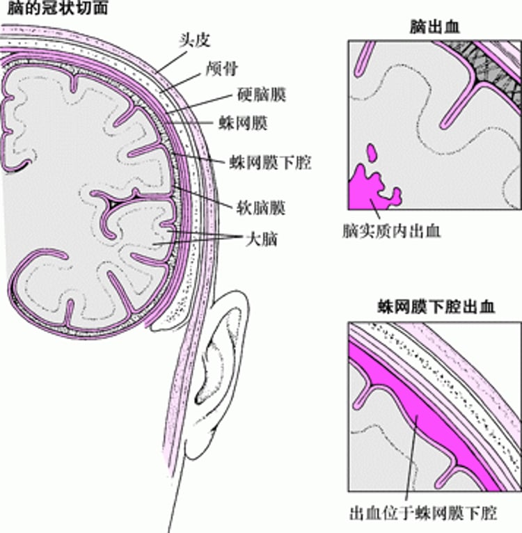 爆发和破裂：出血性卒中的病因