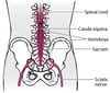 Cauda Equina Syndrome