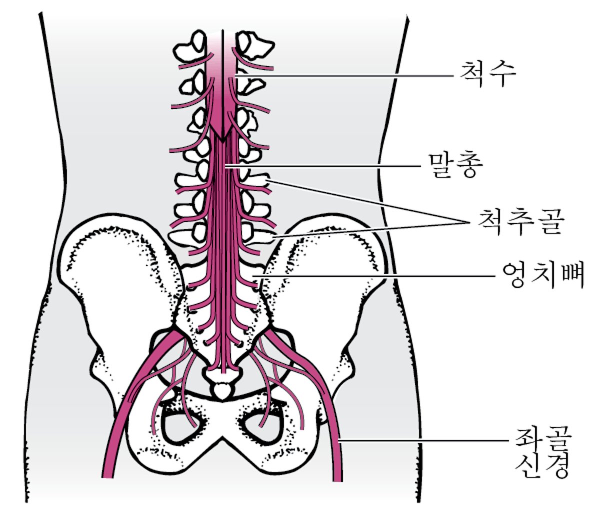 말총 증후군