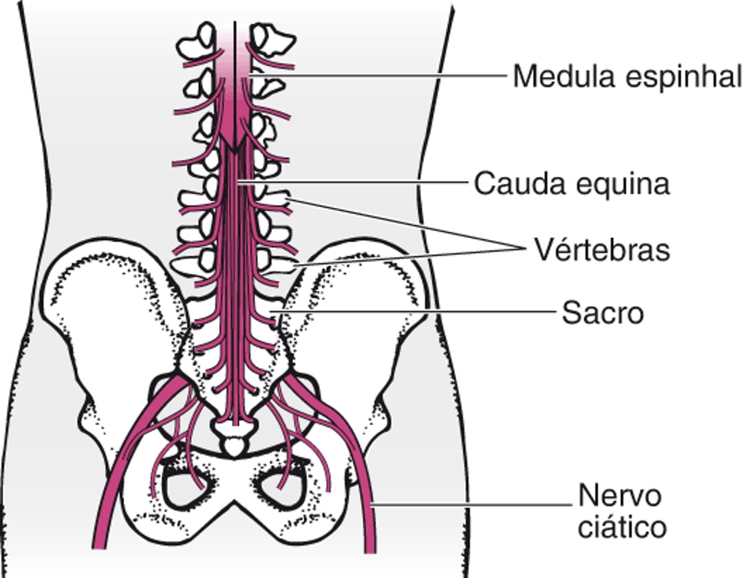 Síndrome da cauda equina