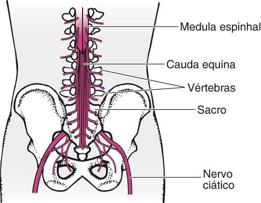 Síndrome da cauda equina - Distúrbios cerebrais, da medula espinal e ...