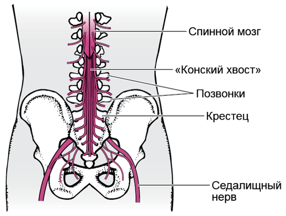 Синдром конского хвоста
