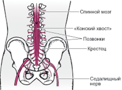Синдром конского хвоста