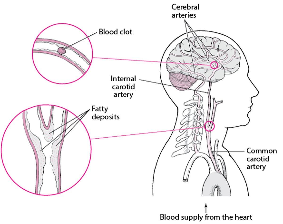 Bursts and Breaks: Causes of Hemorrhagic Stroke