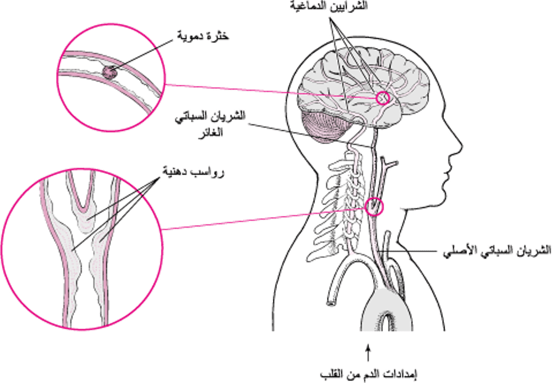 التمزقات والأذيات: أسباب السكتة الدماغية النزفية
