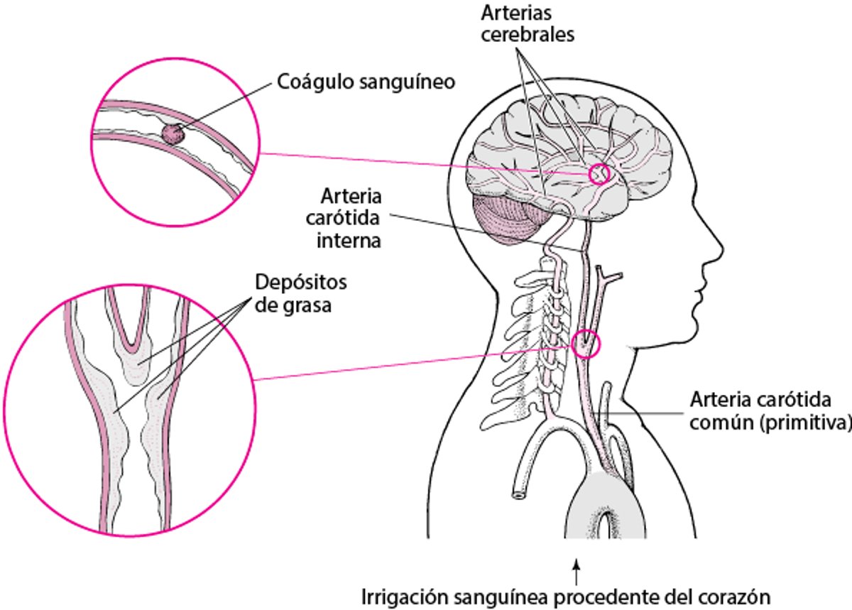 Estallidos y roturas: causas del accidente cerebrovascular hemorrágico (derrame cerebral o ictus hemorrágico)
