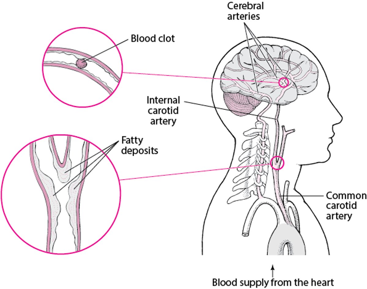 Éclats et ruptures : Causes de l’accident vasculaire cérébral hémorragique