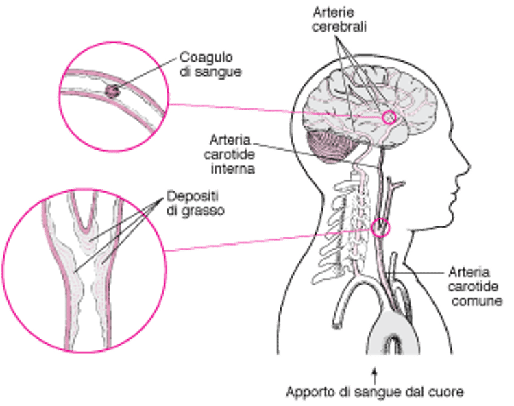 Esplosioni e rotture: cause di ictus emorragico