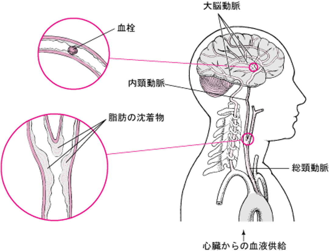 <ruby >破裂<rt >はれつ</rt></ruby>と<ruby >破綻<rt >はたん</rt></ruby>：<ruby >出血性<rt >しゅっけつせい</rt></ruby><ruby >脳卒中<rt >のうそっちゅう</rt></ruby>の<ruby >原因<rt >げんいん</rt></ruby>