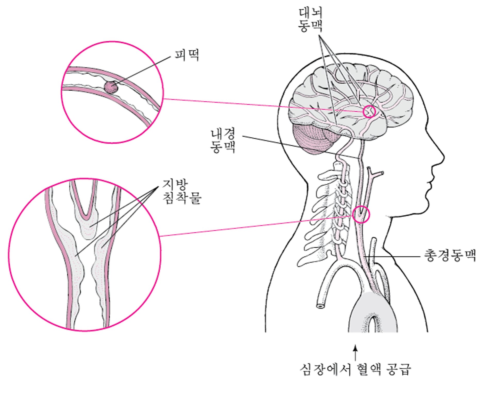 파열 및 손상: 출혈성 뇌졸중의 원인