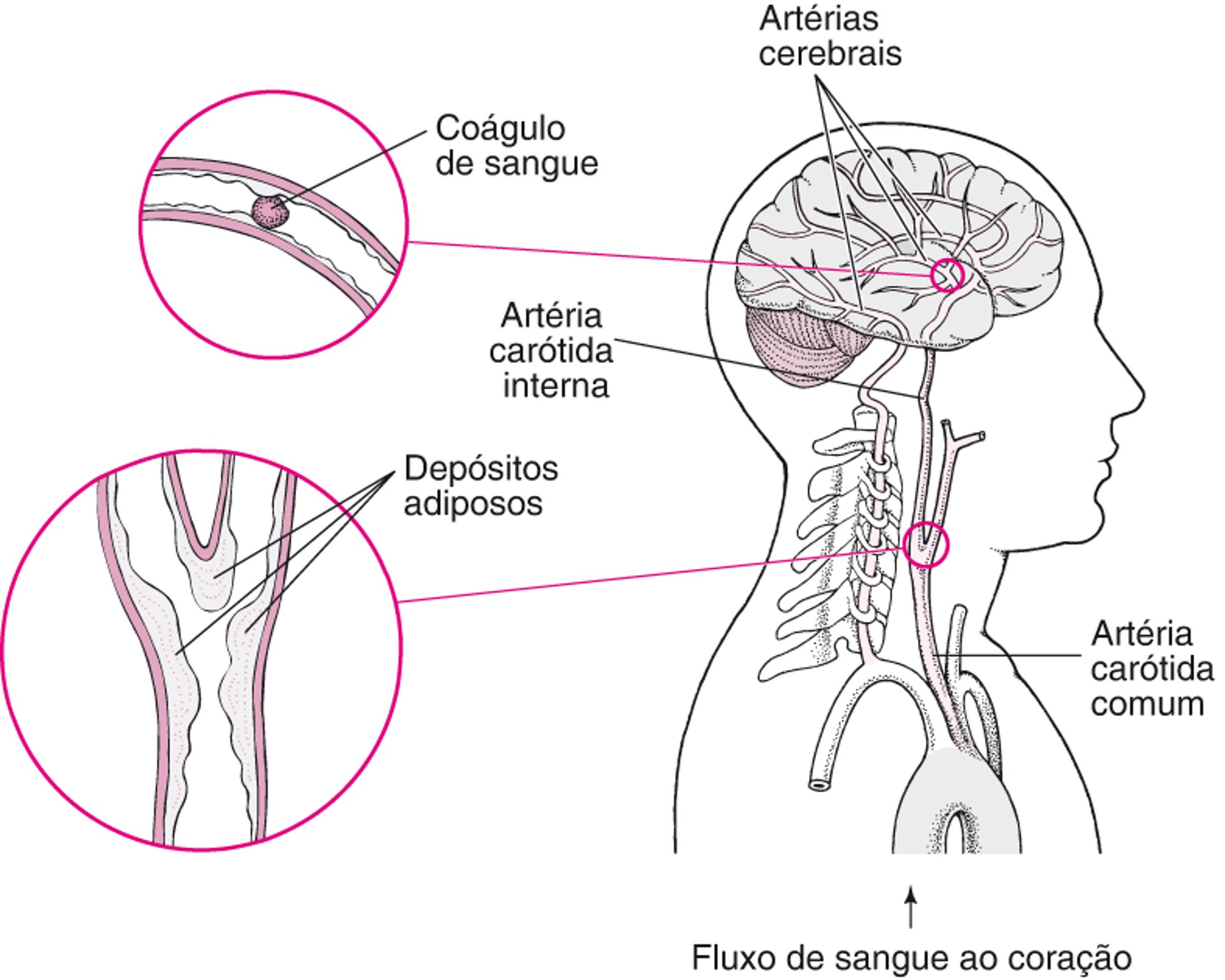 Erupções e rupturas: Causas do acidente vascular cerebral hemorrágico