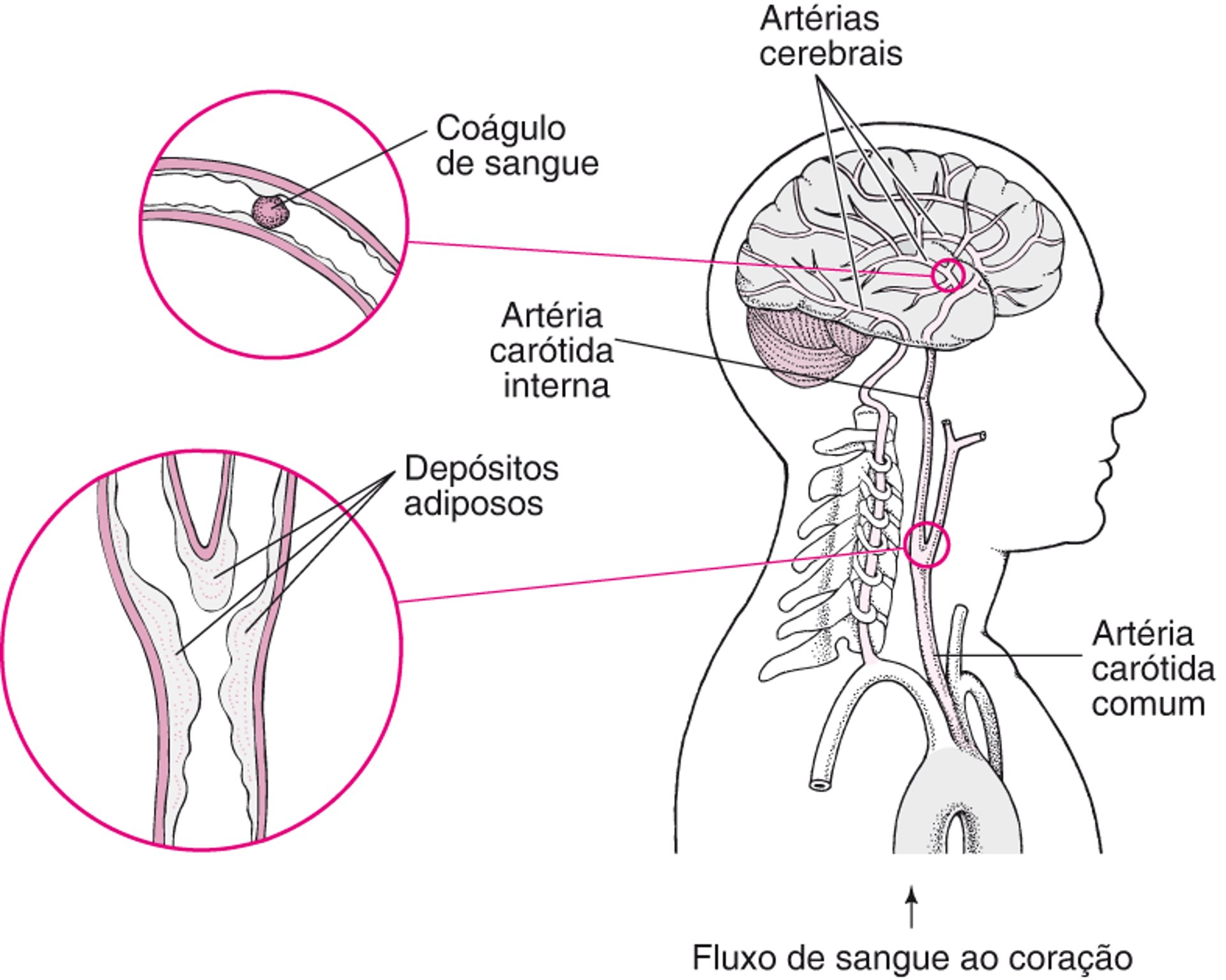 Coágulos: Causas do acidente vascular cerebral isquêmico
