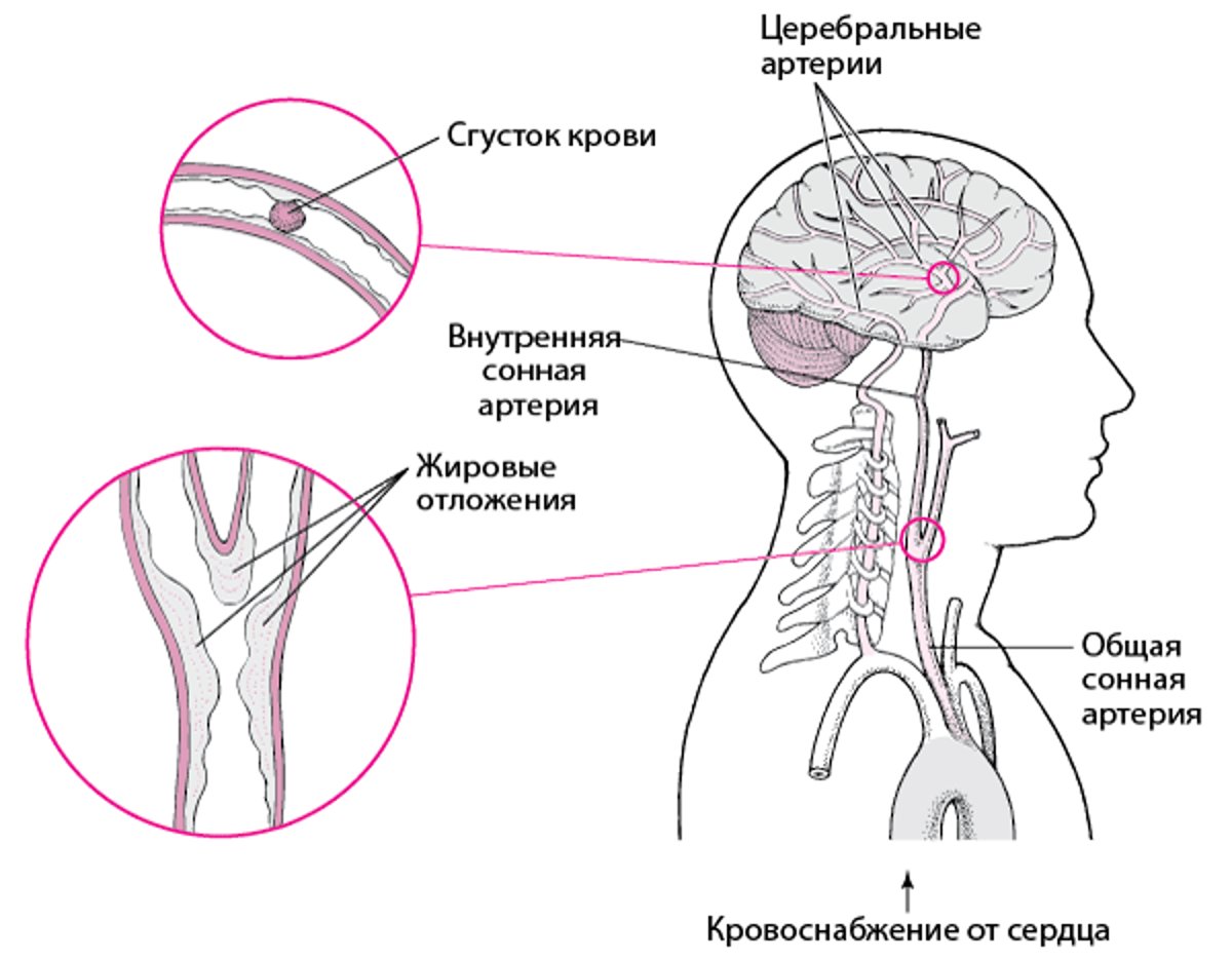 Прорывы и разрывы: причины геморрагического инсульта