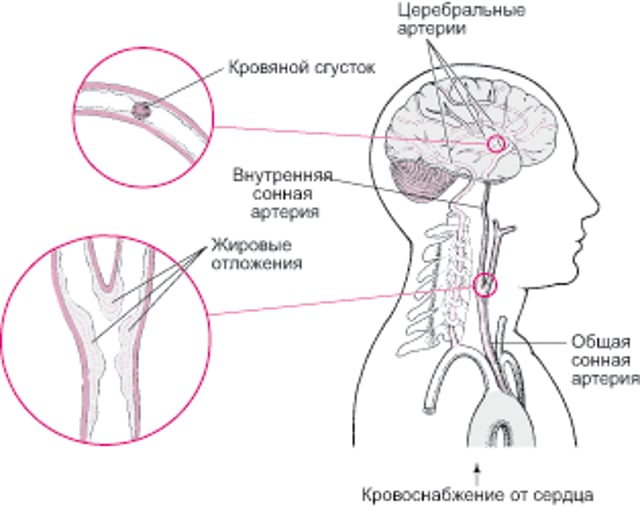 Прорывы и разрывы: причины геморрагического инсульта