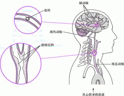 爆发和破裂：出血性卒中的病因